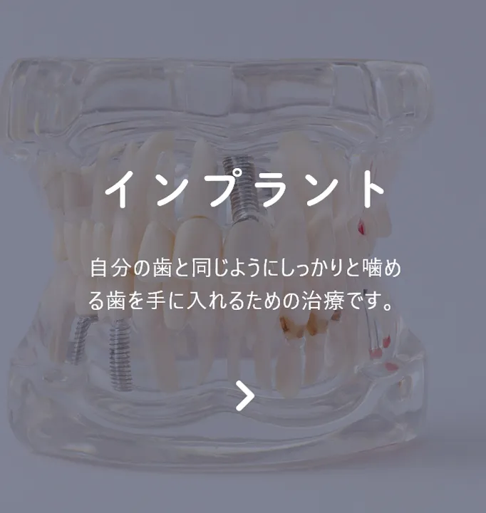 インプラント