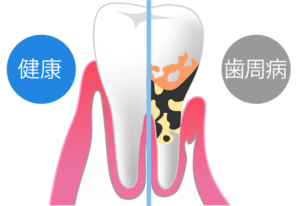 福岡市城南区のいしばし歯科小児矯正歯科クリニック　歯周病とは