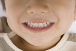 福岡市城南区のいしばし歯科小児矯正歯科クリニック　お子さんのペース合わせた治療